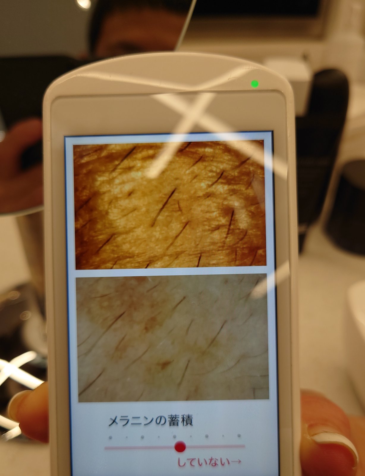 業務用機器の肌診断画面：メラニンの蓄積（中程度）の表示と肌の拡大画像